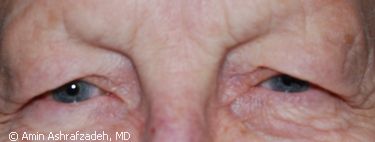Image of patient before eyelid surgery, blepharoplasty